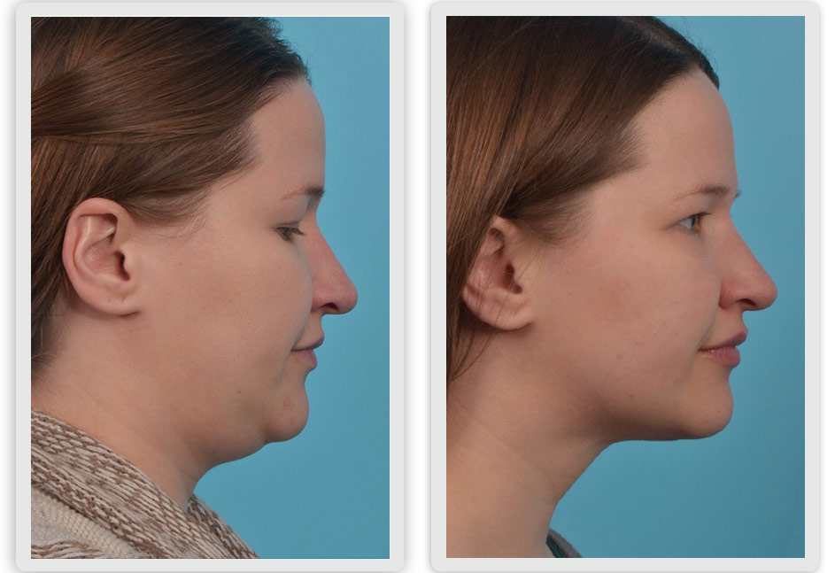 Natural Looking Face and Neck Lift Results A natural looking face