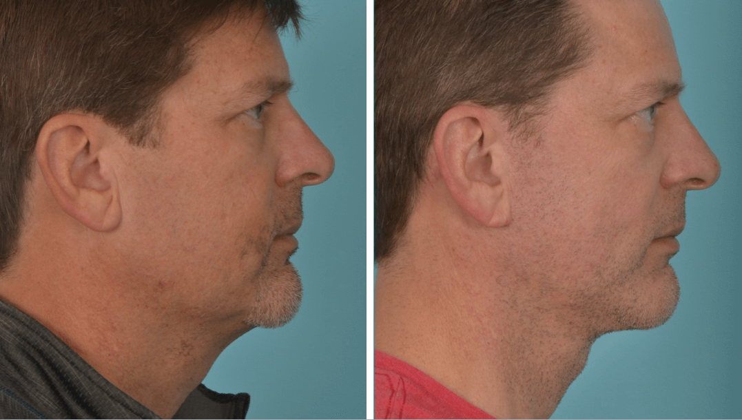 Neck Lift - Before & After - Case 5