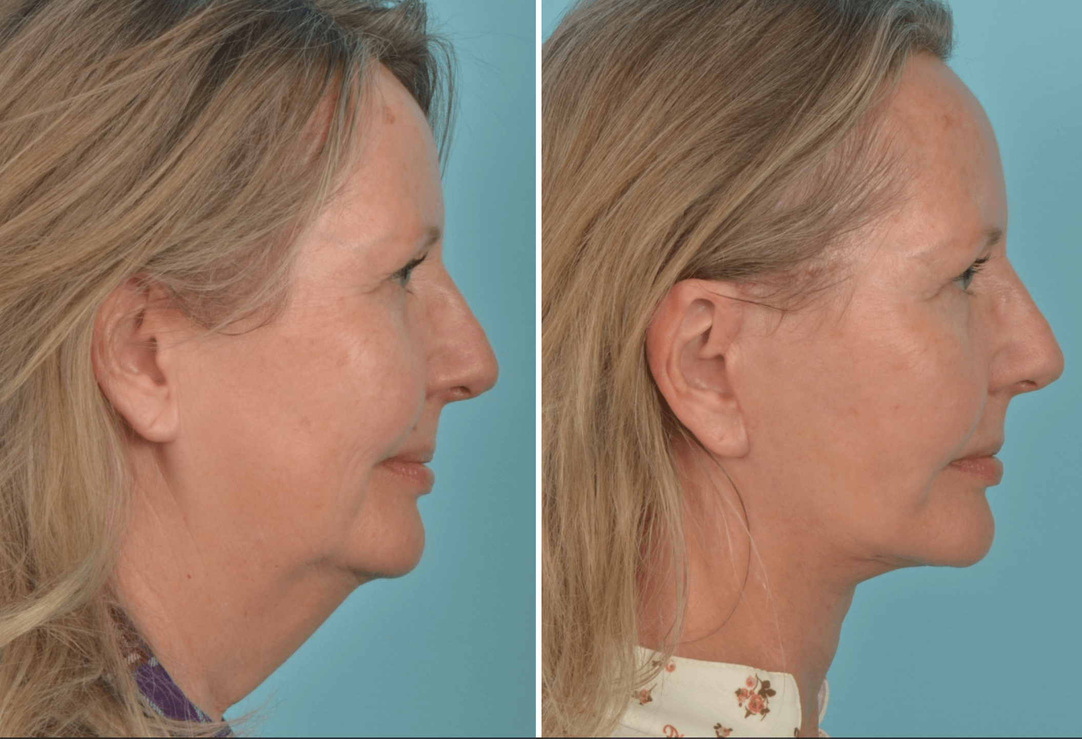 Neck Lift (Platysmaplasty): Surgery, Recovery & What to Expect