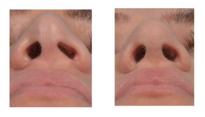 Nostril Stenosis Before and After