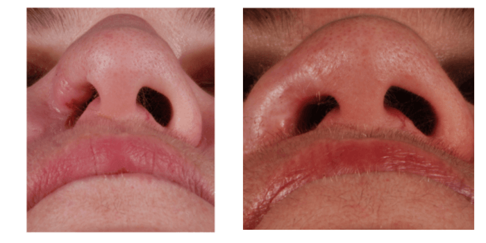 Stenosis surgery Stenosis surgery