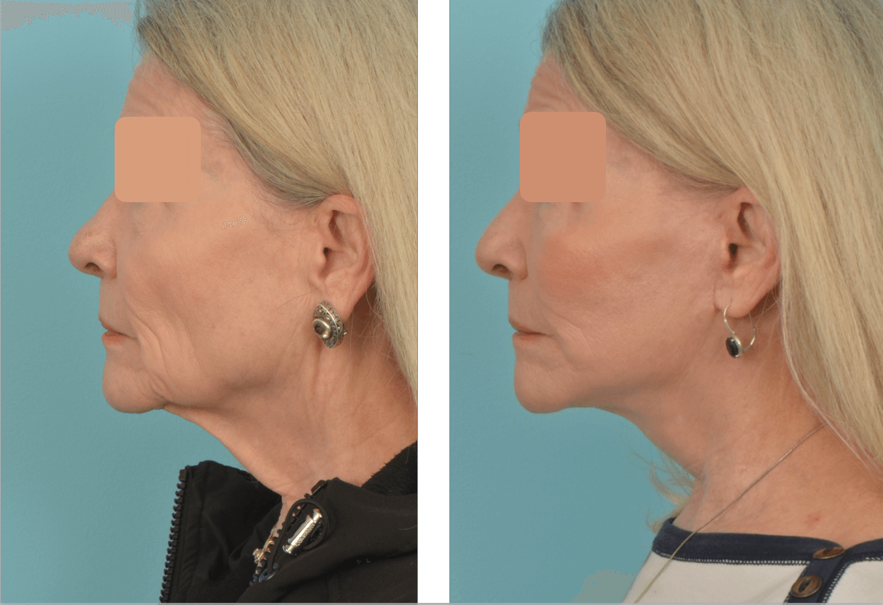 LTC Facelift Profile and Fat Under Eyes, R on eyes