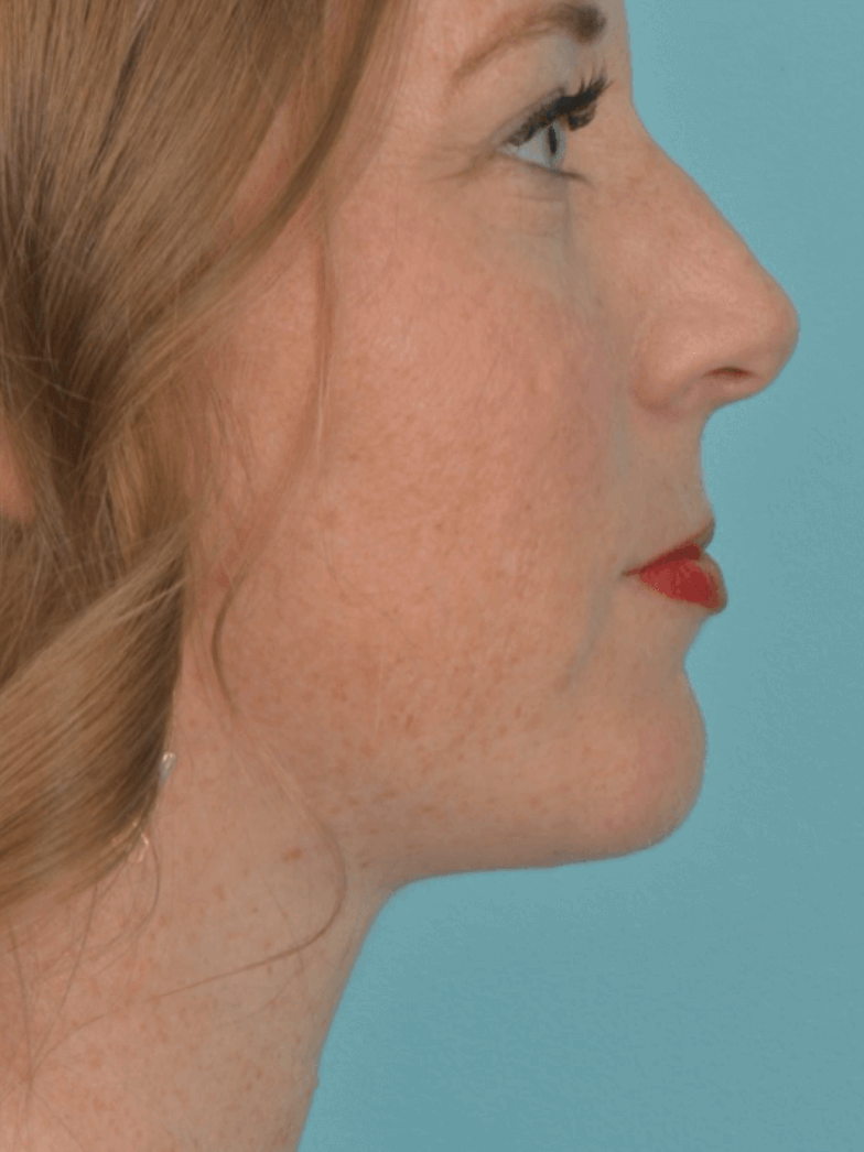 Jawline enhancement- after