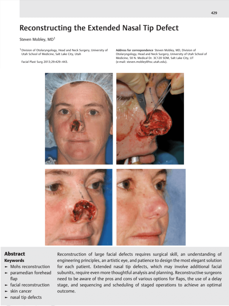 Nasal Reconstruction - Mobley MD