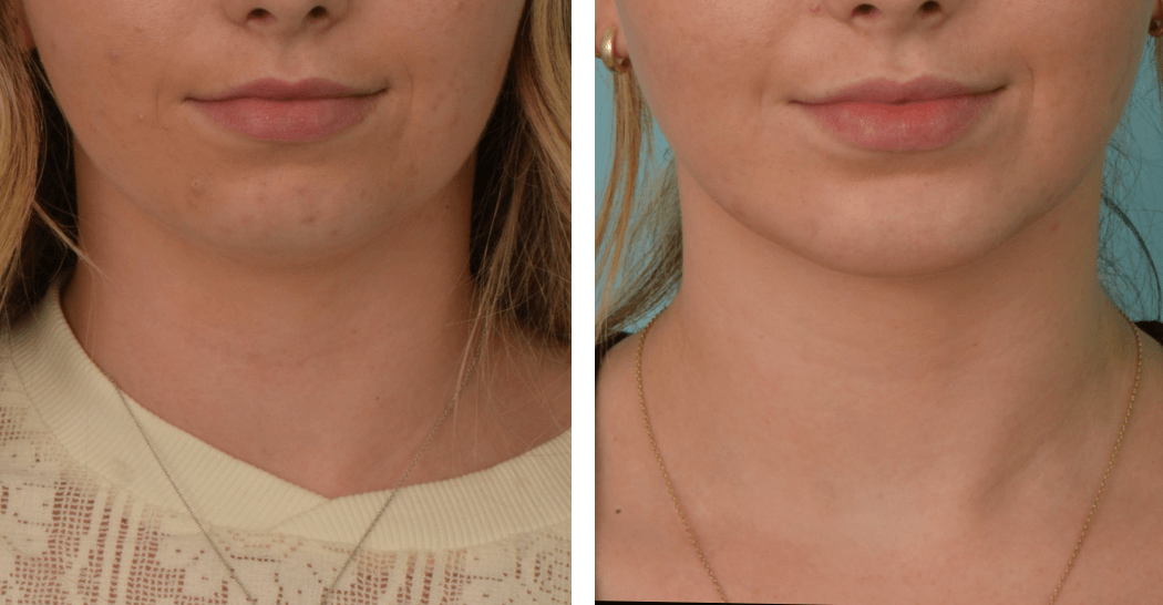 Chin_LG_C60_Frontal