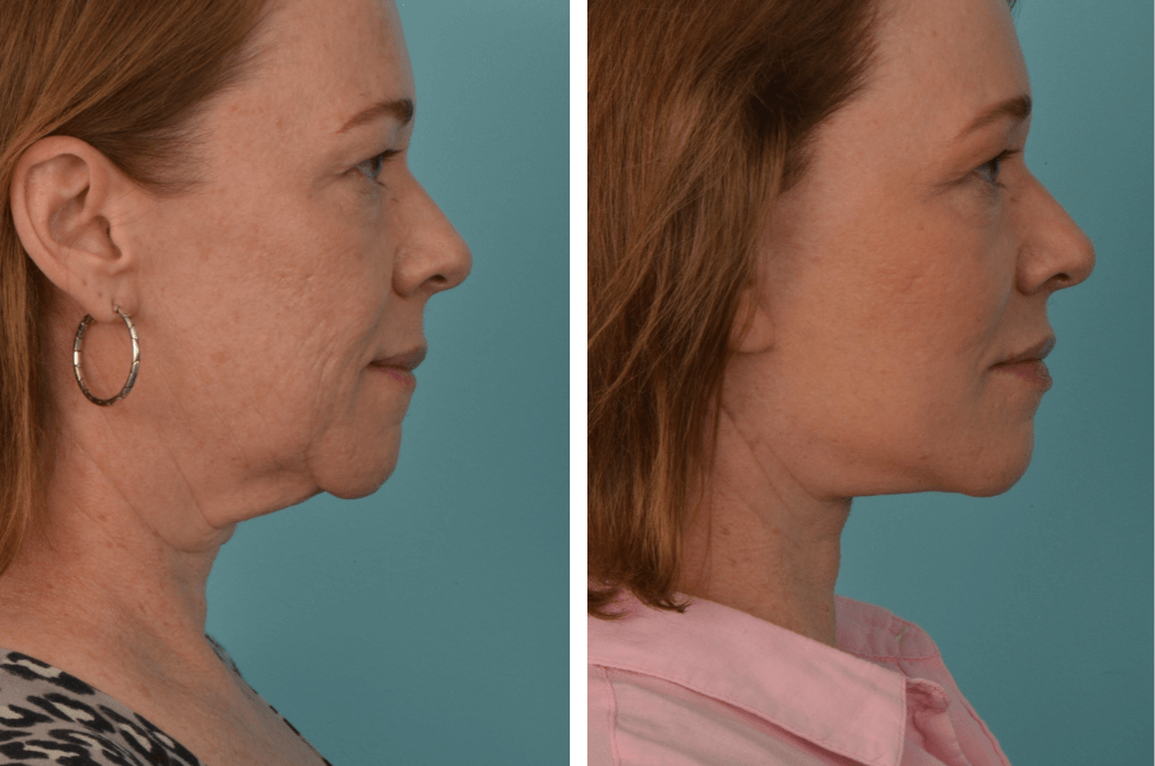 Facelift_MH_C59_Profile