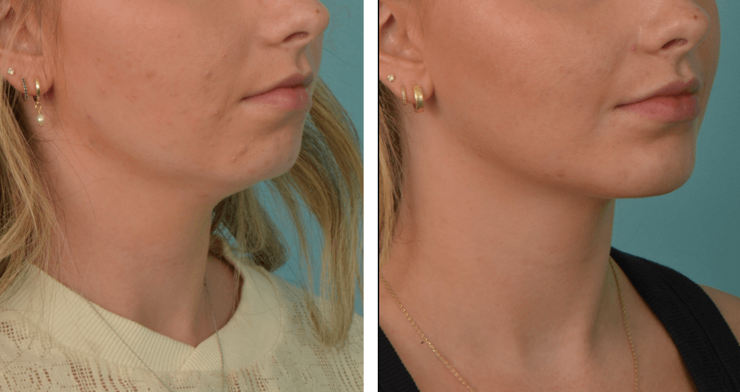 NeckLipo_LG_C60_QR