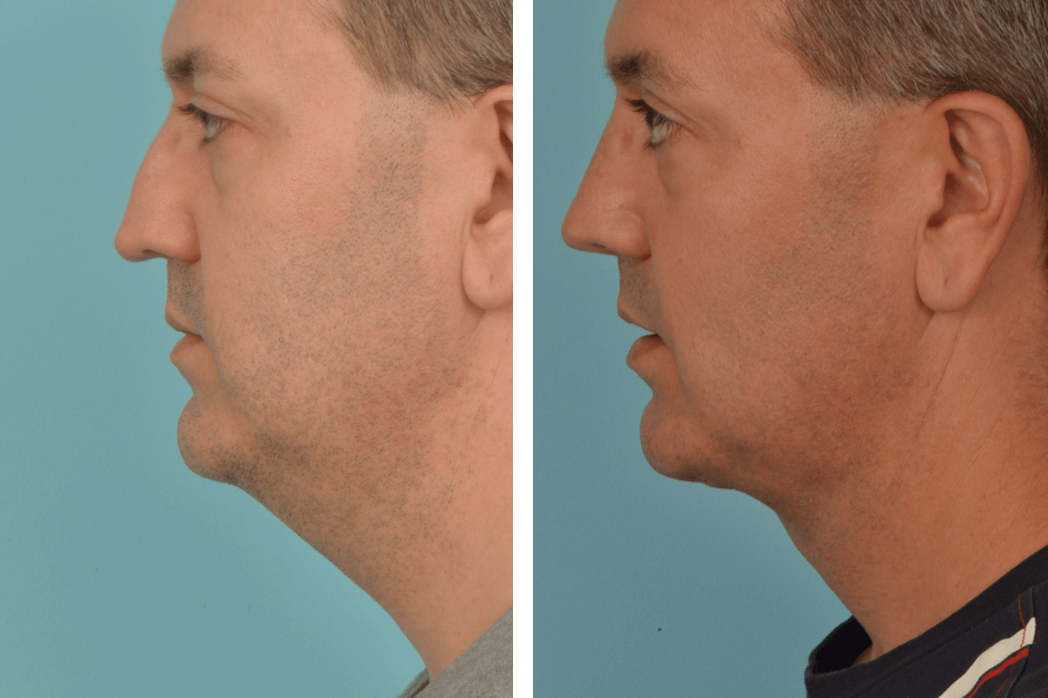 3D_C66_ProfileL