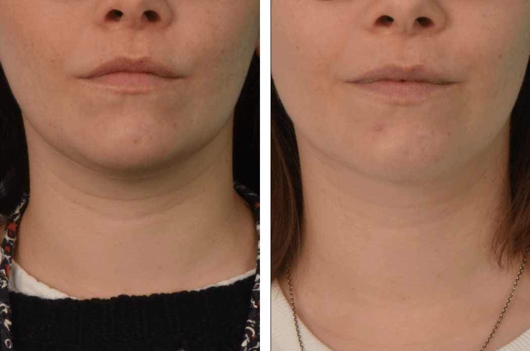 NLipo_NH_C61_Frontal