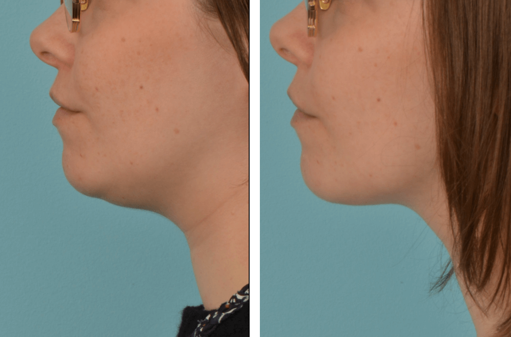 NLipo_NH_C61_Profile