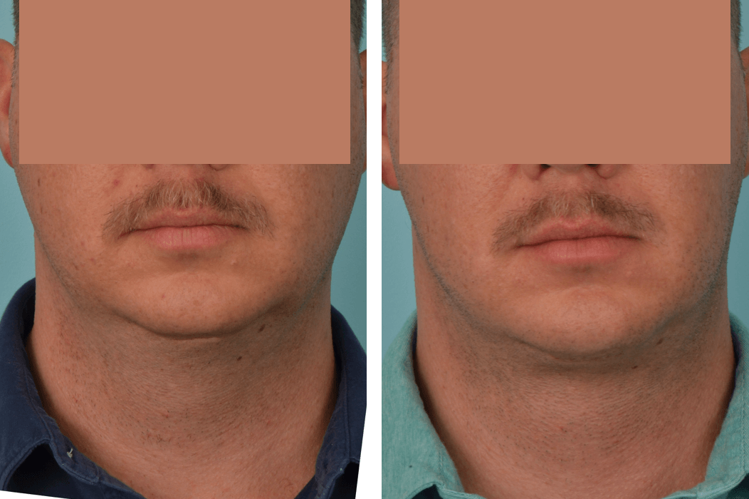 3D_C73_MW_Frontal