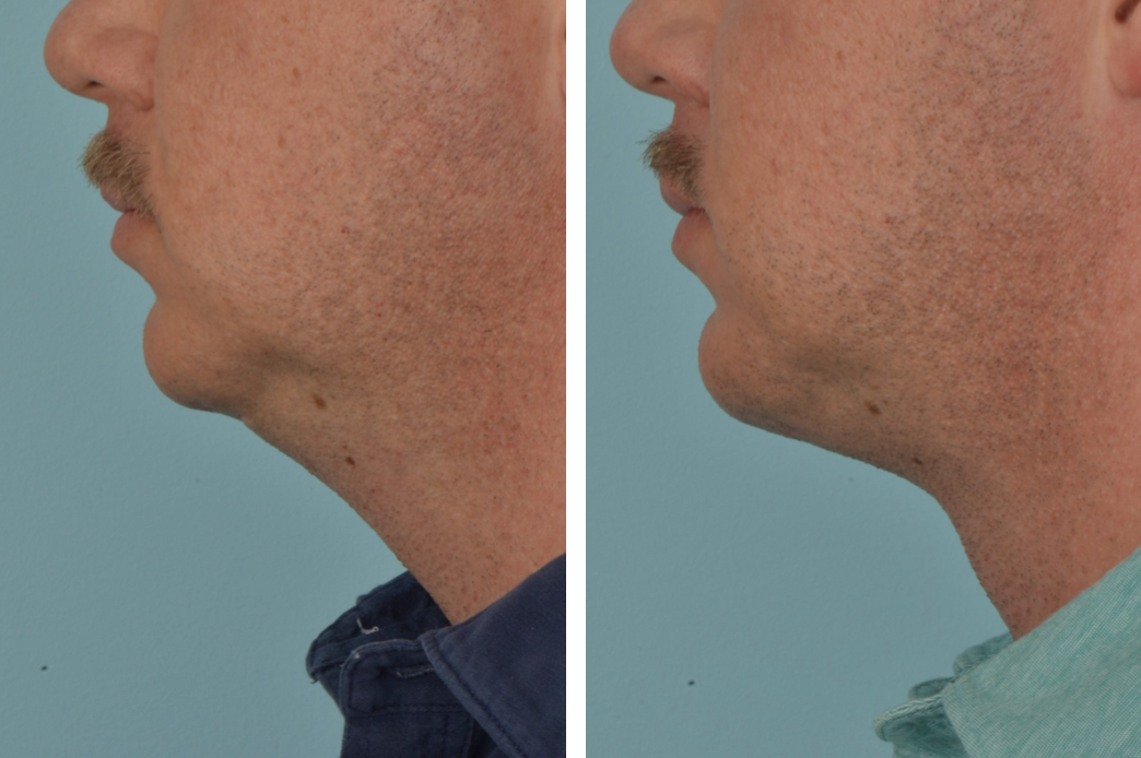 3d_C73_MW_ProfileL