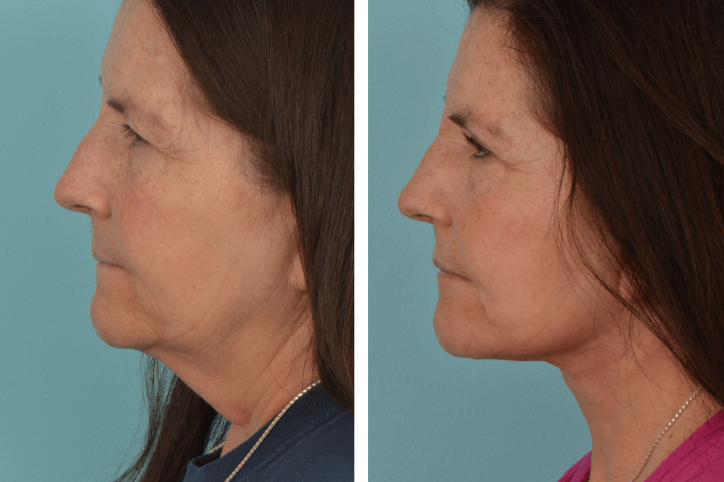 Facelift_KC_C71_ProfileK