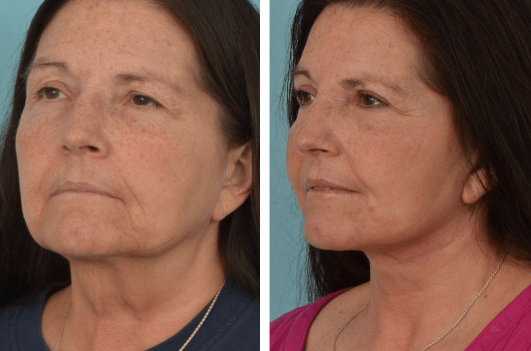 Facelift_KC_C71_Quarter