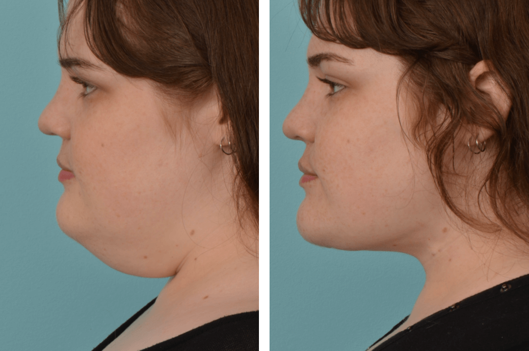 NLipo_TH_C70_ProfileL