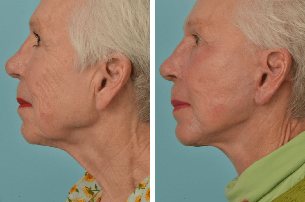 Facelift_CL_C74_ProfileL