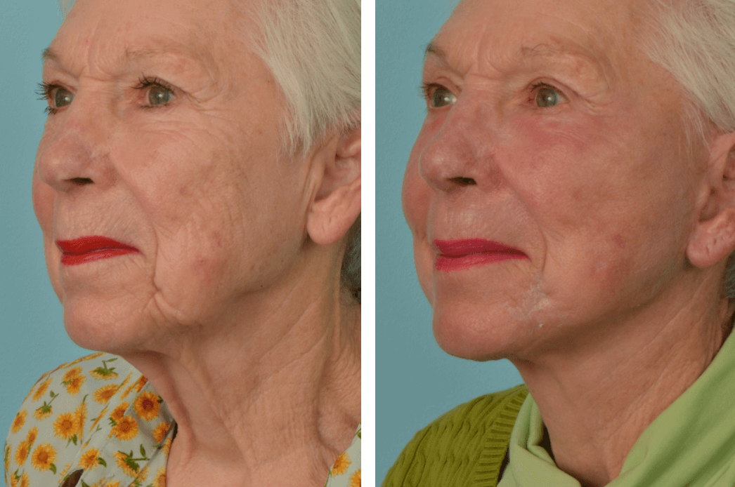 Facelift_CL_C74_QuarterL