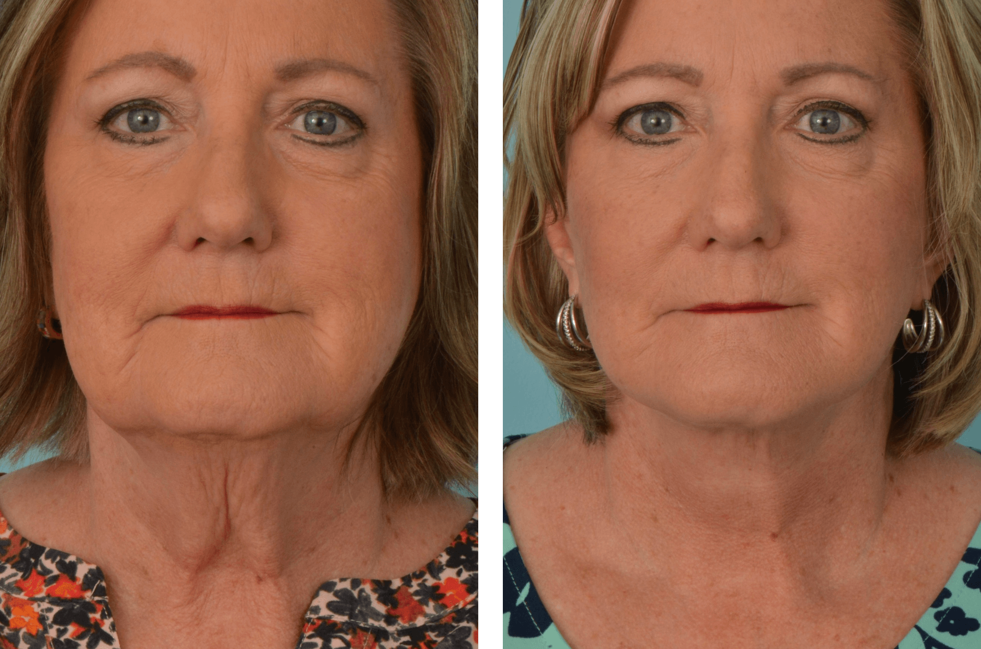 Face:NeckLift_JA_Frontal