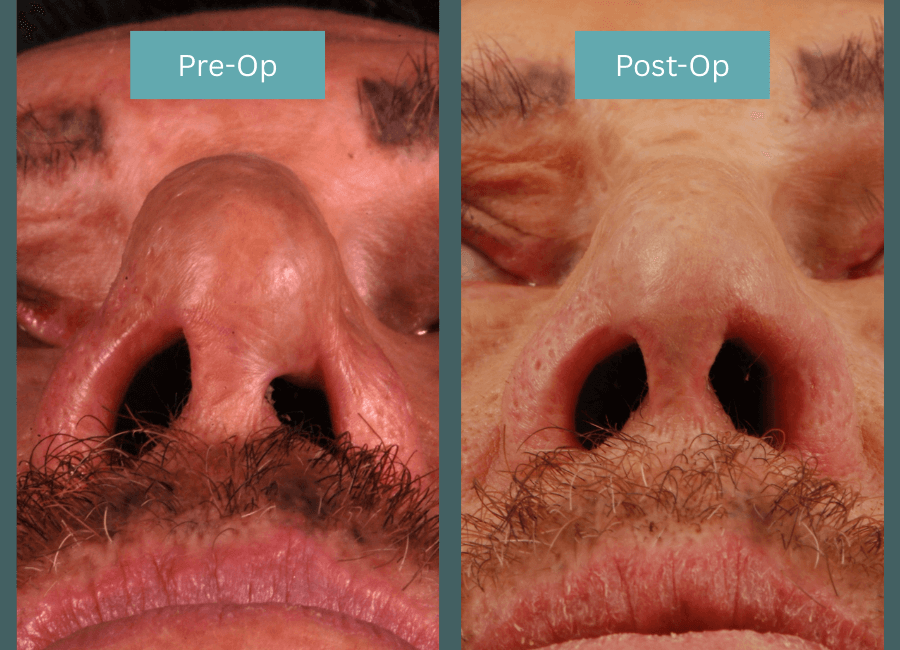 Nostril Stenosis Before & After
