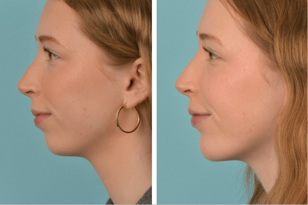 Emma Lindberg_Chin Aug Profile Left