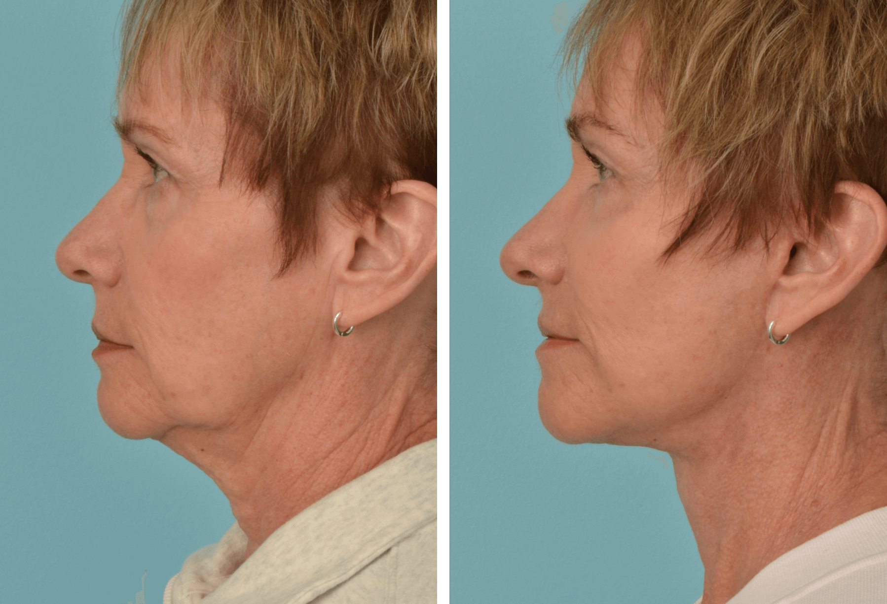 Facelift_Plat_LBleph_LD_ProfileL