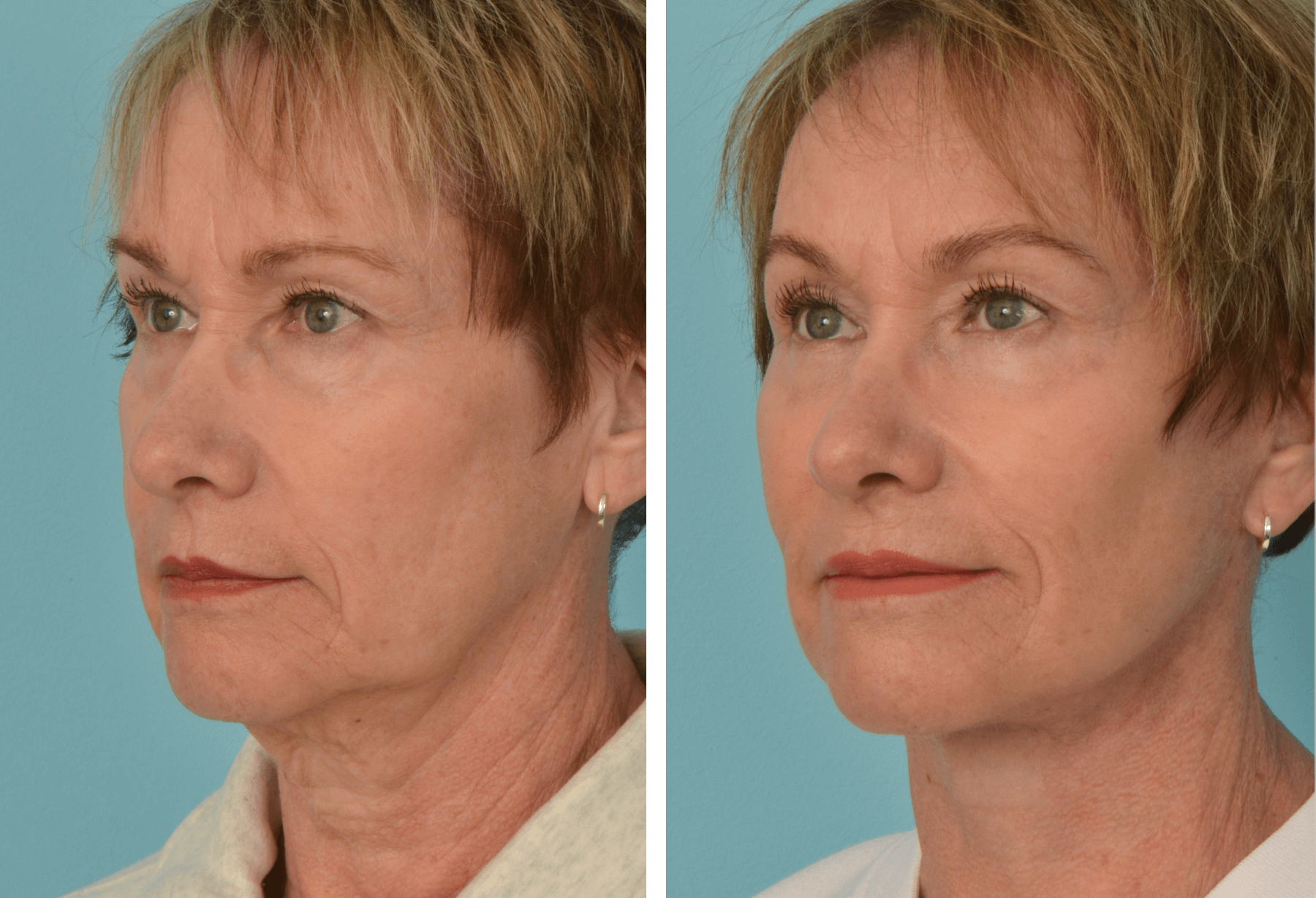 Facelift_Plat_LBleph_LD_QuarterL