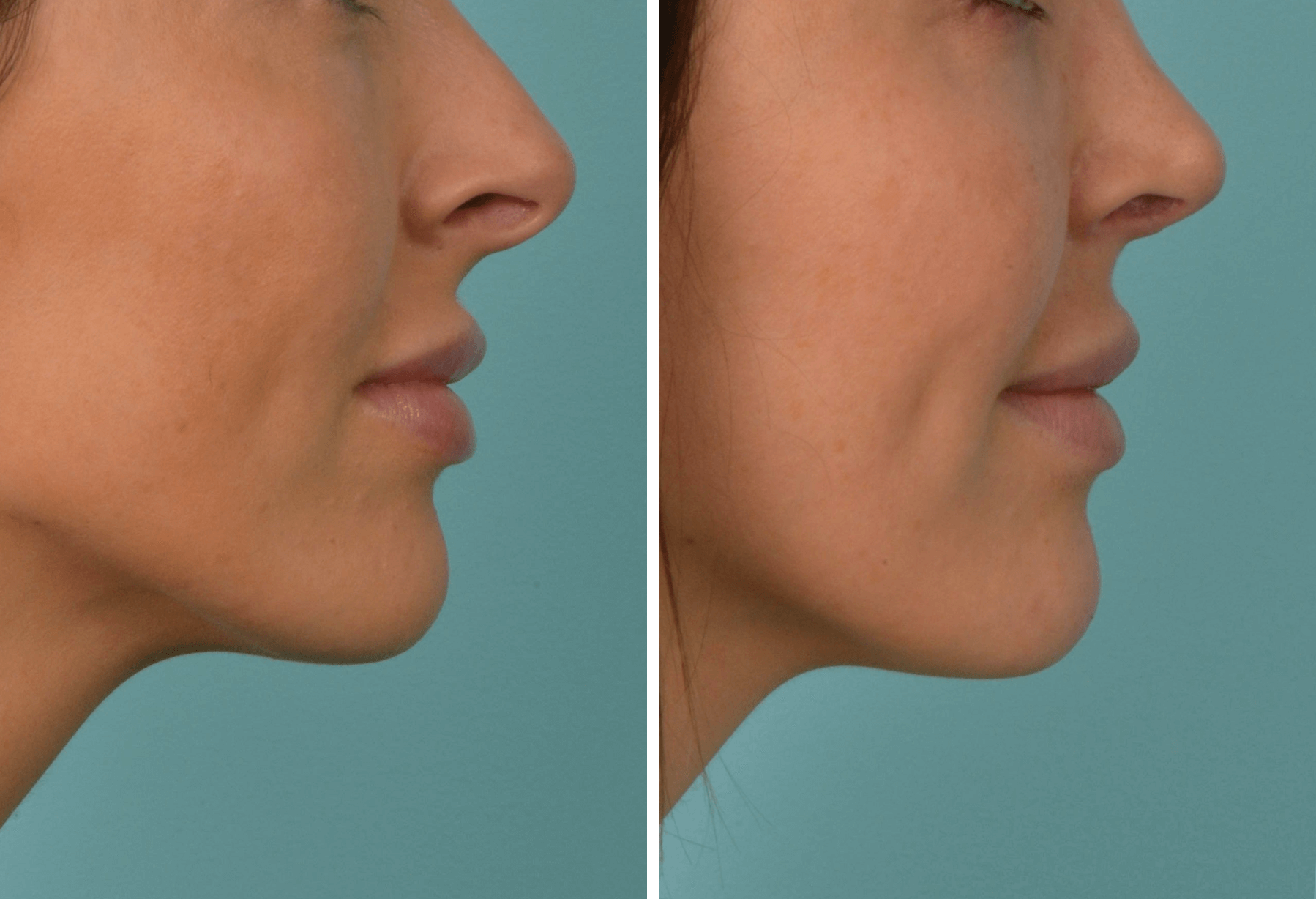 Rhino_AC_ProfileR Case 67