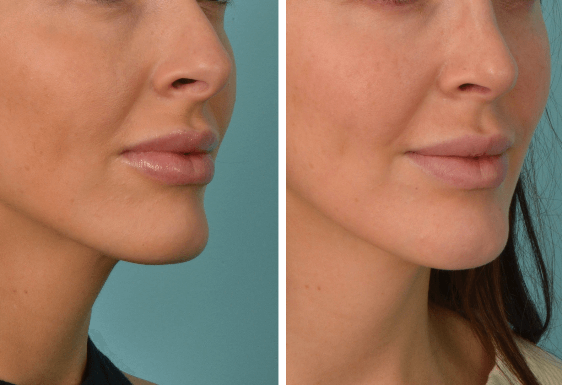 Rhino_AC_QuarterR Case 67