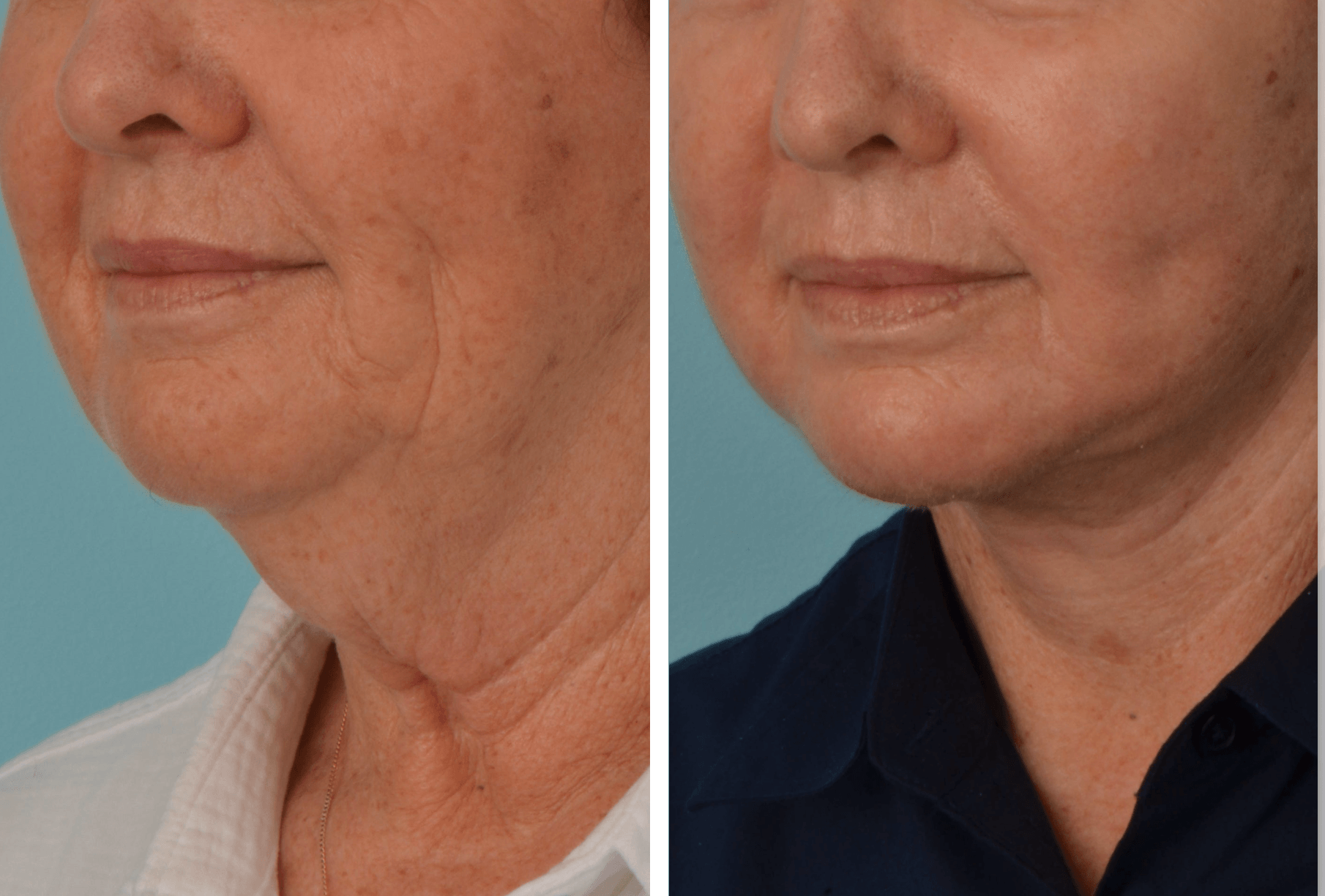 Shauna_Hepworth_Face:Neck_QuarterL